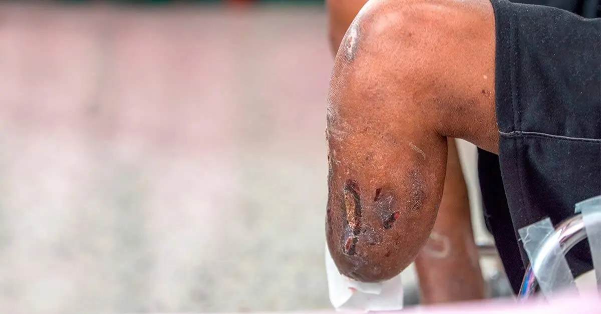 Coto de amputação com ferida na pele