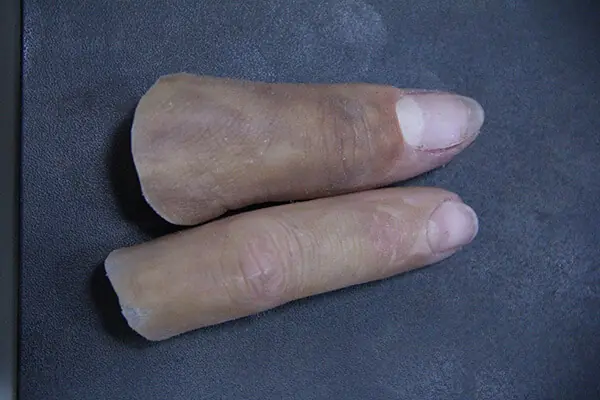 protese-estetica